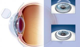 icl人工晶体植入手术